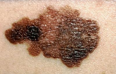 Tecnología de última generación para el cáncer de piel